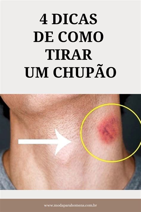 como tirar chupada|Como Se Livrar de Um Chupão Da Noite pro Dia: 9 Passos